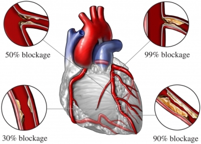 heart with blockage
